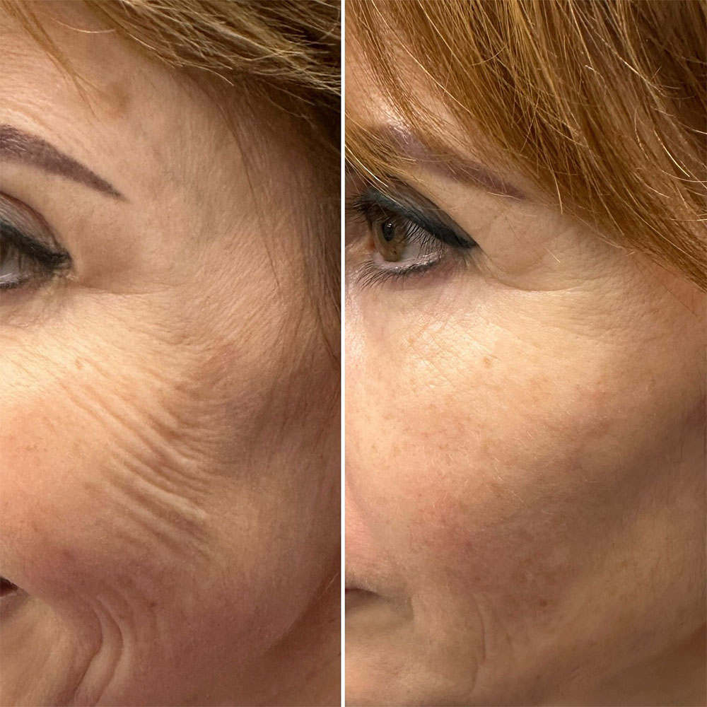 Microneedling with Exosomes Before and After Results